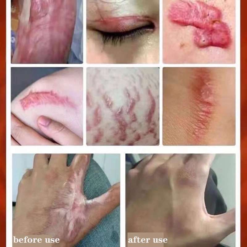 Acne Surgical Scar Removal Cream Pimples Stretch Marks Face Gel Remove Acne Smoothening Whitening Body Skin Care Pigmentatio