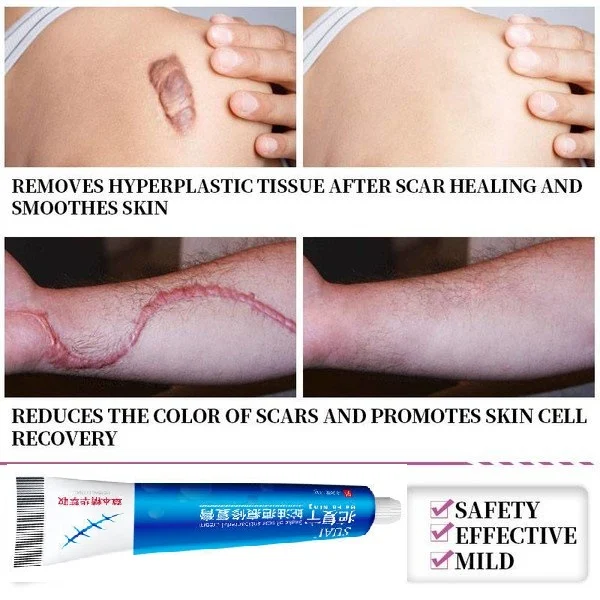 SUAT Acne Scar Stretch Marks Remover Cream Skin Repair Face Cream Acne Spots Acne Treatment Blackhead Whitening Cream Skin Care--mutima.rw