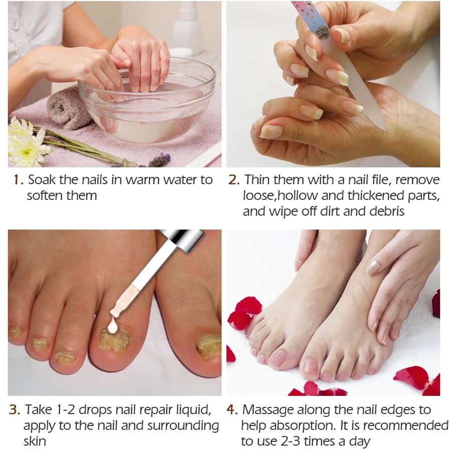 Fungal Nail Treatment Cream Nail Repair Gel Hand Foot Nail Fungus Treatment Onychomycosis Removal Anti Fungus Nail Repair Care71941586