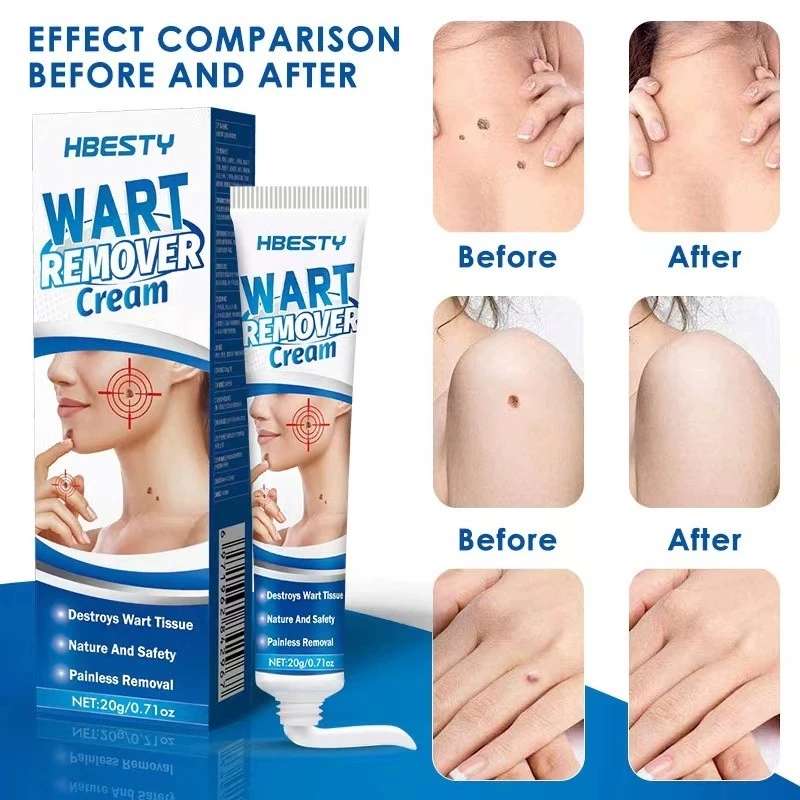 Skin Tag Remover Cream Painless Mole Skin Dark Spot Warts Remover Serum Freckle Face Wart Tag Treatment Removal Essential O