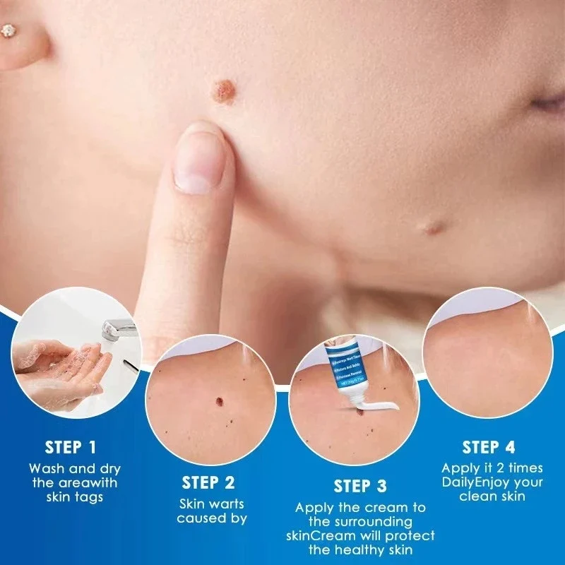 Skin Tag Remover Cream Painless Mole Skin Dark Spot Warts Remover Serum Freckle Face Wart Tag Treatment Removal Essential Oi