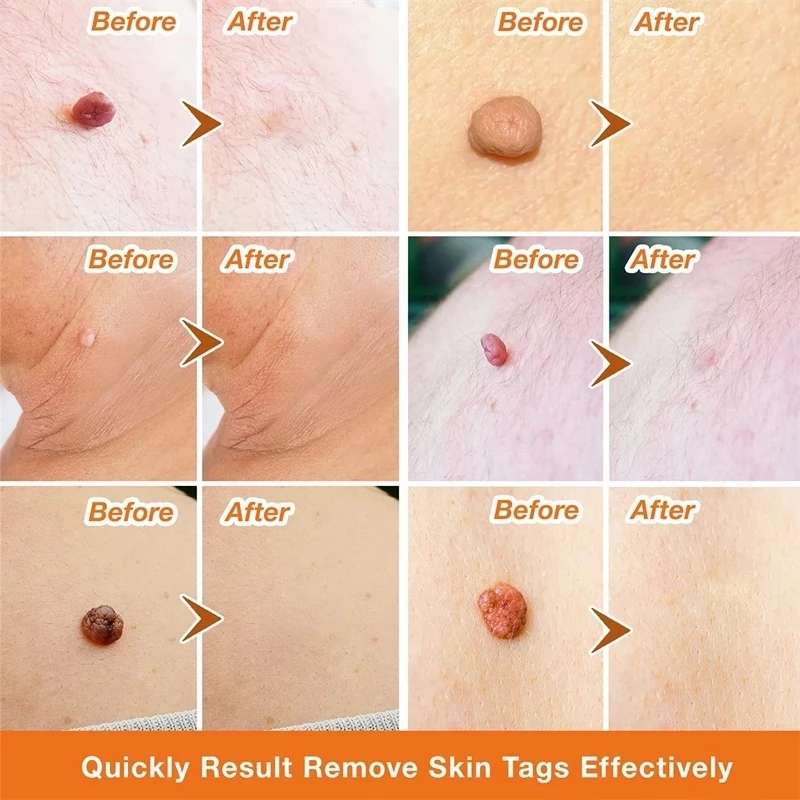 Skin Tag Remover Cream Painless Mole Skin Dark Spot Warts Remover Serum Freckle Face Wart Tag Treatment Removal Essential