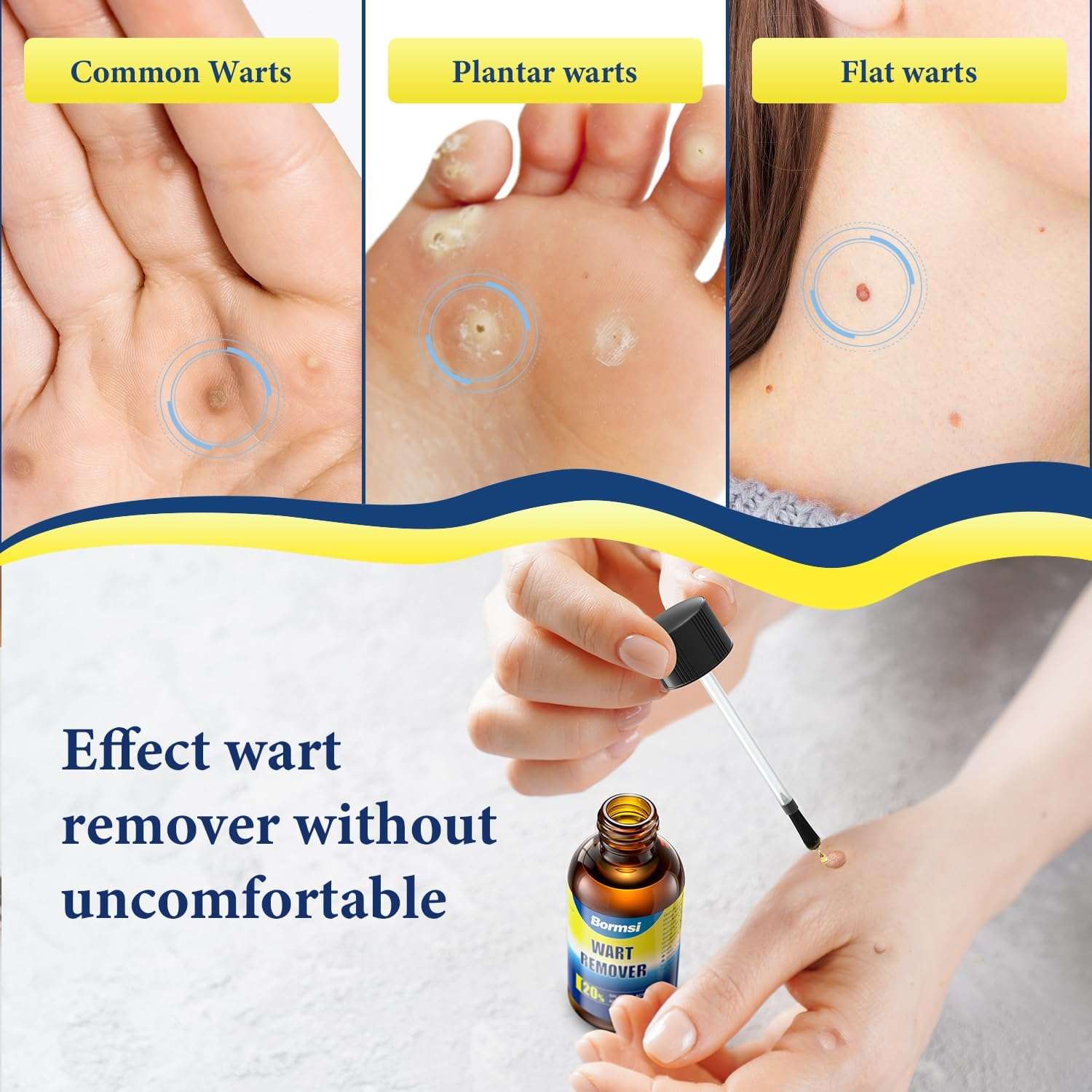 Wart Remover,Maximum Strength Salicylic Acid Liquid Fast-Acting for Plantar, Common and Flat Wart Removal Treatment,Safe for Children and Adults,30ml 00_